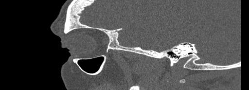 Bilateral Ectopic Infraorbital Nerves (Radiopaedia 49006-54084 Sagittal bone window 47).jpg