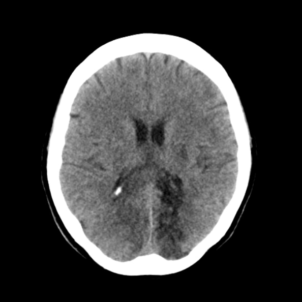 File:Bilateral PCA territory infarction - different ages (Radiopaedia 46200-50591 Axial non-contrast 13).jpg