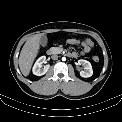 File:Bilateral accessory renal arteries with mild pelvi-ureteric junction (PUJ) obstruction (Radiopaedia 66357-75596 A 22).jpg