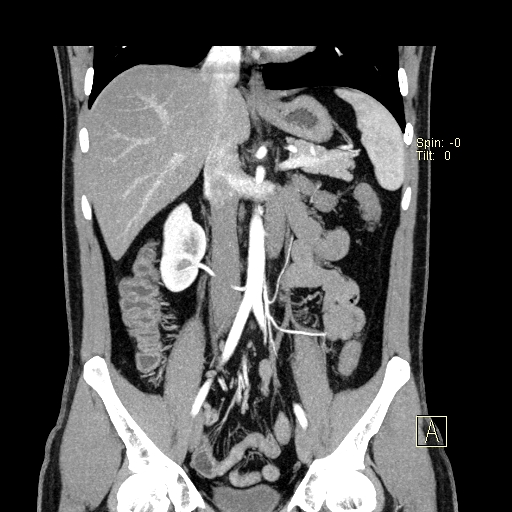 File:Bilateral accessory renal arteries with mild pelvi-ureteric junction (PUJ) obstruction (Radiopaedia 66357-75596 B 15).jpg