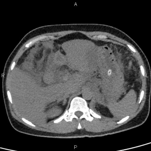 Bilateral adrenal gland hyperenhancement in pancreatitis (Radiopaedia 86642-102753 Axial non-contrast 26).jpg