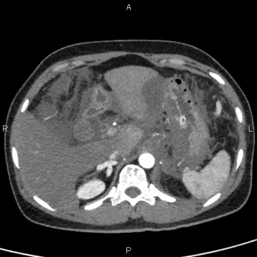 File:Bilateral adrenal gland hyperenhancement in pancreatitis (Radiopaedia 86642-102753 B 31).jpg