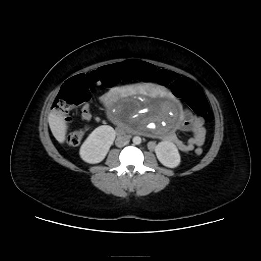 Bilateral adrenal thrombosis (Radiopaedia 58182-65256 A 37).jpg
