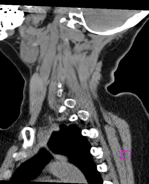 Bilateral atlanto-occipital assimilation (Radiopaedia 28350-28603 D 21).jpg