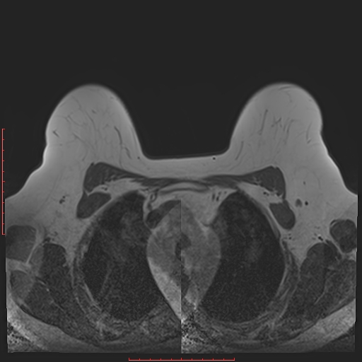 File:Bilateral breast implant rupture (Radiopaedia 24761-25027 T1 8).jpg