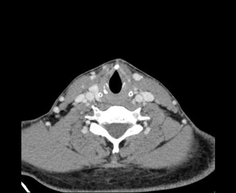 File:Bilateral carotid body tumors (Radiopaedia 61841-69870 Axial Post contrast 79).jpg