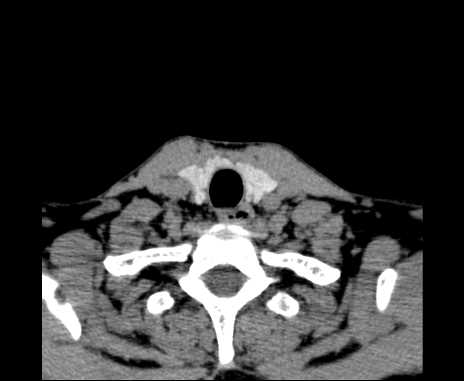 Bilateral carotid body tumors (Radiopaedia 61841-69870 Axial non-contrast 98).jpg