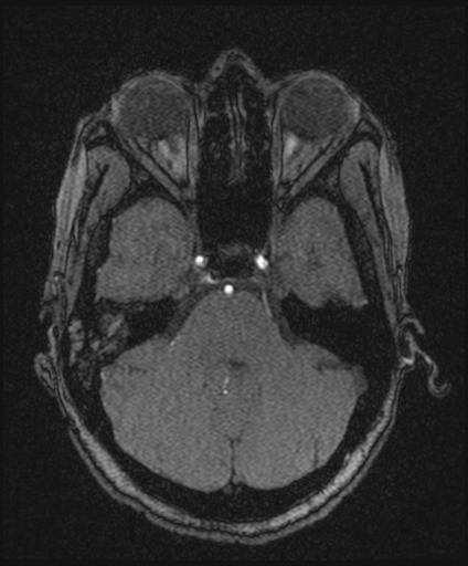Bilateral carotid body tumors and right glomus jugulare tumor (Radiopaedia 20024-20060 Axial MRA 50).jpg