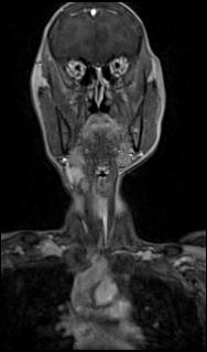 File:Bilateral carotid body tumors and right glomus jugulare tumor (Radiopaedia 20024-20060 MRA 8).jpg