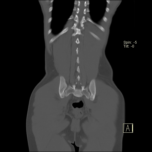 File:Bilateral cortical nephrocalcinosis (Radiopaedia 73165-83886 Coronal bone window 26).jpg