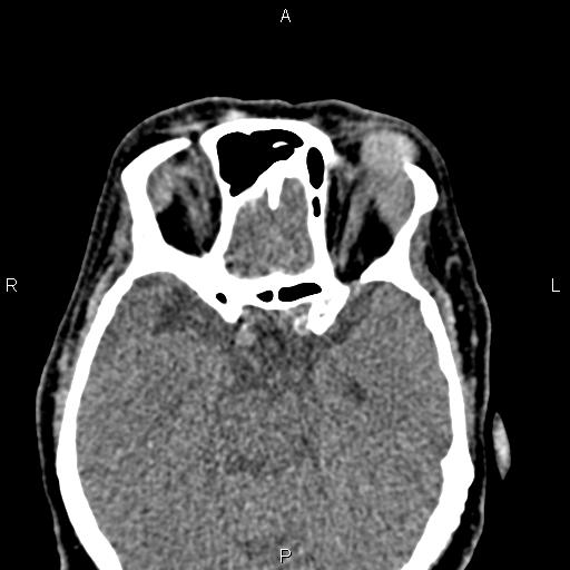 Bilateral enlargement of lacrimal glands - sarcoidosis (Radiopaedia 62627-70921 Axial non-contrast 58).jpg