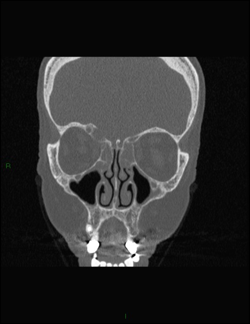 Bilateral frontal mucoceles (Radiopaedia 82352-96454 Coronal 123).jpg
