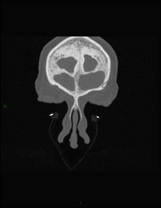 Bilateral frontal mucoceles (Radiopaedia 82352-96454 Coronal 46).jpg