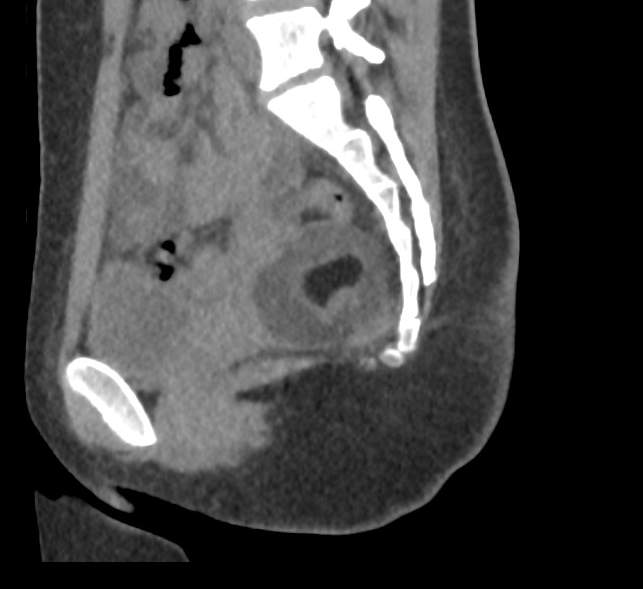 Bilateral mature cystic ovarian teratoma (Radiopaedia 88821-105592 D 38).jpg