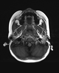File:Bilateral mesial temporal polymicrogyria (Radiopaedia 76456-88181 Axial T1 2).jpg