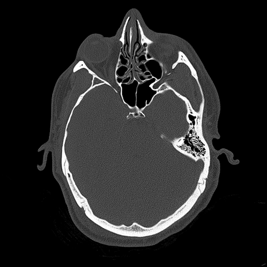 Bilateral occipital condyle fracture (type 2) (Radiopaedia 87675-104089 Axial bone thins 89).jpg