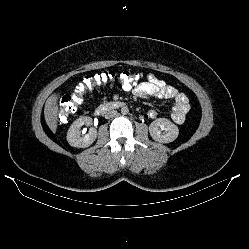 Bilateral ovarian dermoid cysts (Radiopaedia 85785-101603 Axial C+ delayed 34).jpg