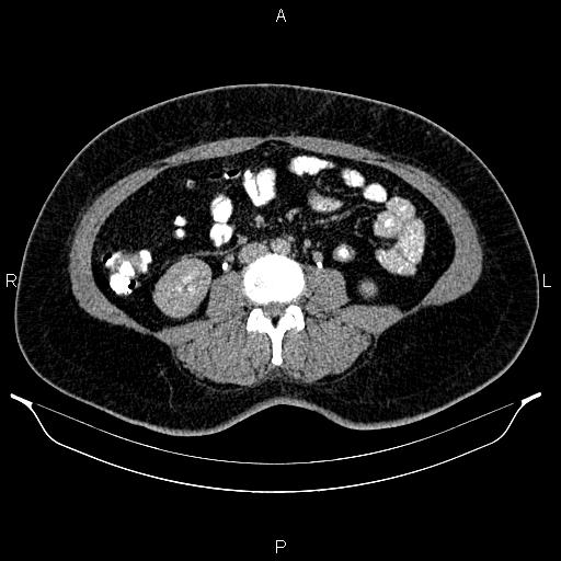 Bilateral ovarian dermoid cysts (Radiopaedia 85785-101603 Axial C+ delayed 40).jpg