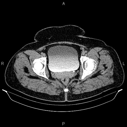 Bilateral ovarian dermoid cysts (Radiopaedia 85785-101603 Axial C+ delayed 81).jpg