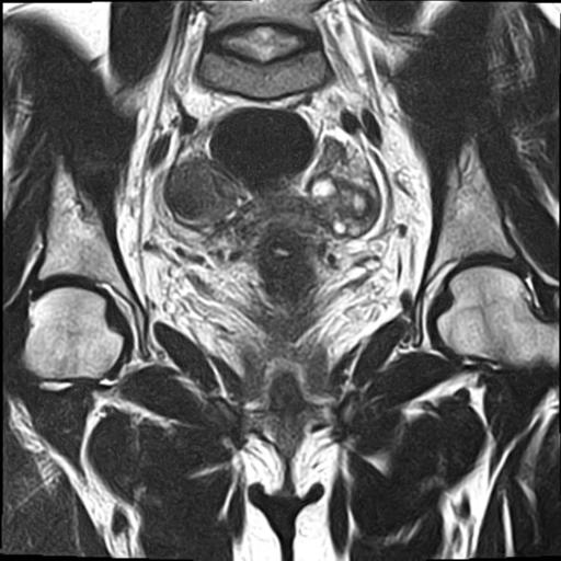 File:Bilateral ovarian endometriomas (Radiopaedia 87085-103347 Coronal T2 10).jpg
