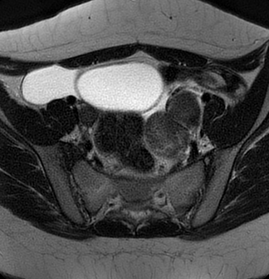 File:Bilateral ovarian fibrothecomas - adolescent (Radiopaedia 86604-102707 Axial T2 15).jpg