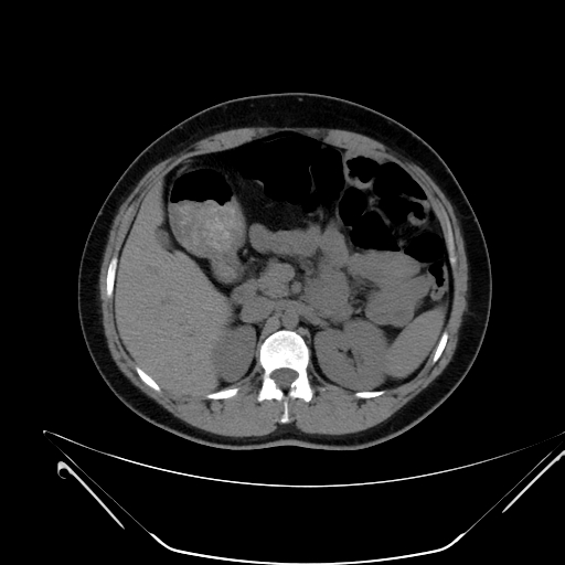 File:Bilateral ovarian mature cystic teratomas (Radiopaedia 79373-92457 Axial non-contrast 11).jpg