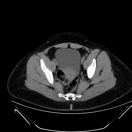 Bilateral ovarian mature cystic teratomas (Radiopaedia 79373-92457 Axial non-contrast 66).jpg