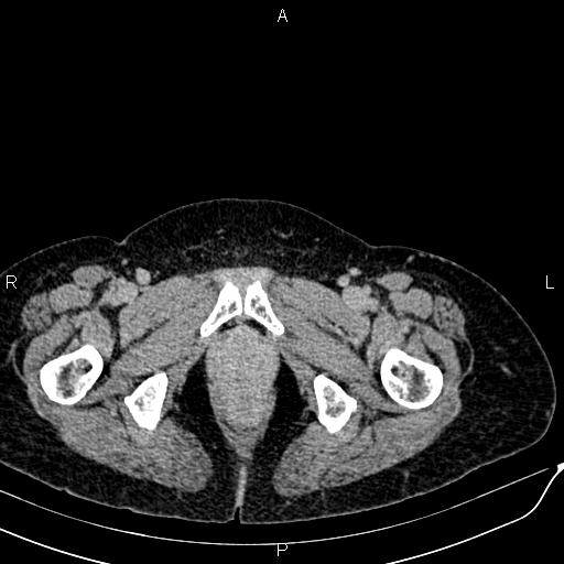File:Bilateral ovarian serous cystadenocarcinoma (Radiopaedia 86062-101989 Axial C+ delayed 87).jpg