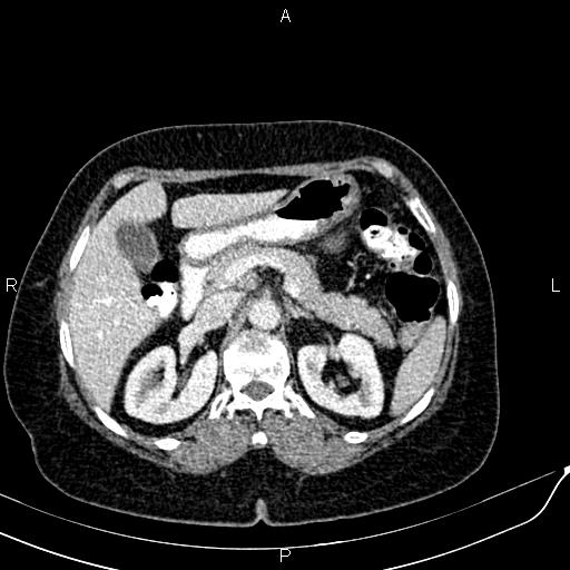 Bilateral ovarian serous cystadenocarcinoma (Radiopaedia 86062-101989 B 32).jpg