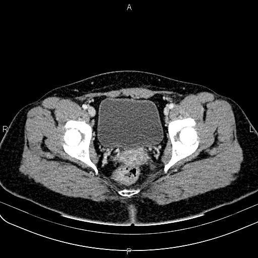 Bilateral ovarian teratoma (Radiopaedia 83131-97503 Axial With contrast 62).jpg