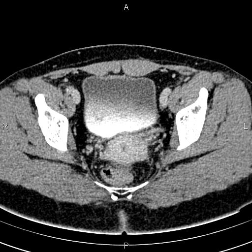 File:Bilateral ovarian teratoma (Radiopaedia 83131-97503 B 54).jpg