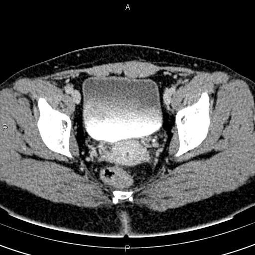 Bilateral ovarian teratoma (Radiopaedia 83131-97503 B 57).jpg