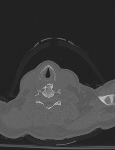 File:Bilateral perched facet joint (Radiopaedia 63149-71669 Axial bone window 46).jpg