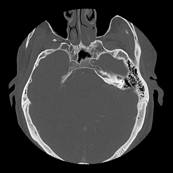File:Bilateral perched facets with cord injury (Radiopaedia 45587-49713 Axial bone window 1).jpg