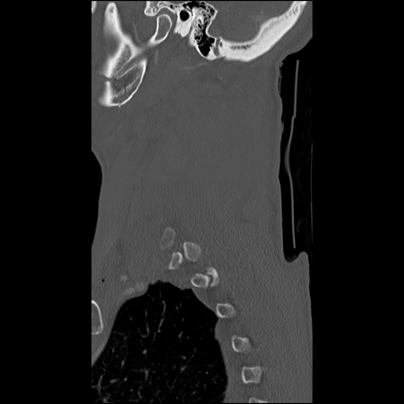 Bilateral perched facets with cord injury (Radiopaedia 45587-49713 Sagittal bone window 48).jpg