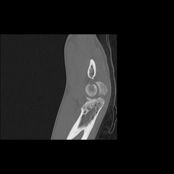 File:Bilateral proximal radioulnar synostosis (Radiopaedia 66532-75812 B 18).jpg