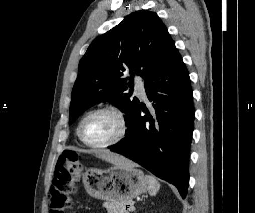 Bilateral pulmonary AVM (Radiopaedia 83134-97505 D 78).jpg