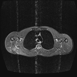 File:Bilateral spinoglenoid notch ganglion cysts (Radiopaedia 29577-30082 E 13).jpg