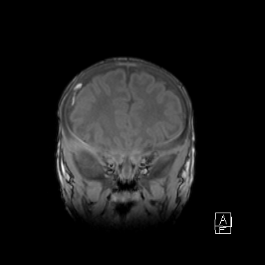 Bilateral subdural hemorrhage and parietal skull fracture (Radiopaedia 26058-26190 Coronal T1 14).png