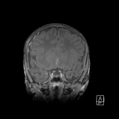 Bilateral subdural hemorrhage and parietal skull fracture (Radiopaedia 26058-26190 Coronal T1 19).png