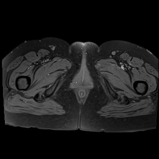 Bilateral tubo-ovarian abscesses (Radiopaedia 58635-65829 Axial T1 fat sat 49).jpg