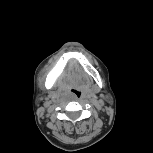 Bisphosphonate-related osteonecrosis of the jaw (Radiopaedia 71324-81642 non-contrast 51).jpg