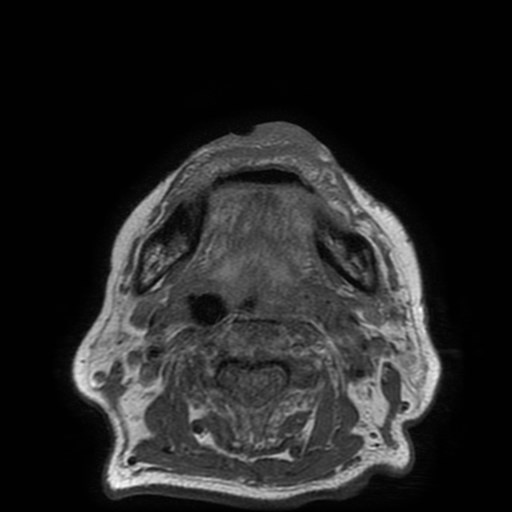 Bisphosphonate-related osteonecrosis of the maxilla (Radiopaedia 51367-57101 Axial T1 9).jpg