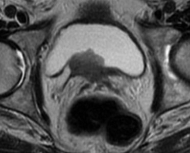 File:Bladder cancer invading the ureteral ostium (Radiopaedia 14168-14026 B 1).jpg