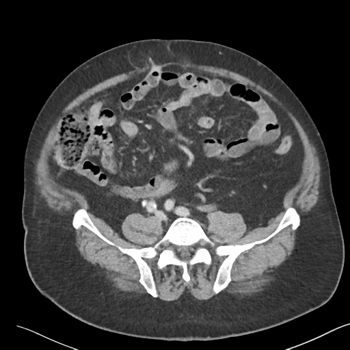 File:Bladder papillary urothelial carcinoma (Radiopaedia 48119-52951 Axial 37).png