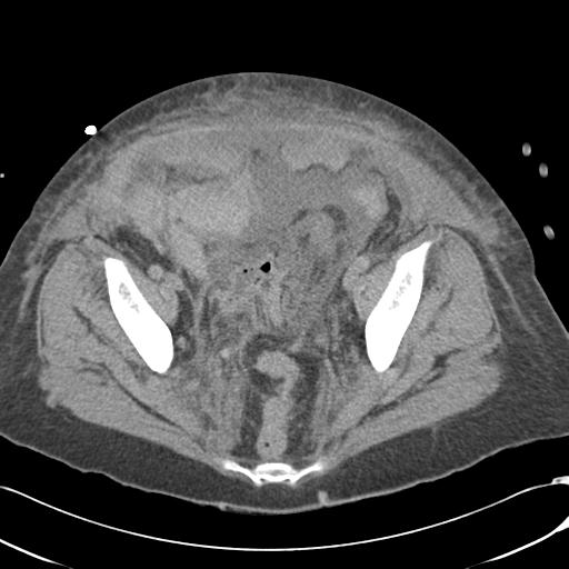 File:Bladder rupture post renal biopsy (Radiopaedia 30863-31572 Axial non-contrast 73).jpg