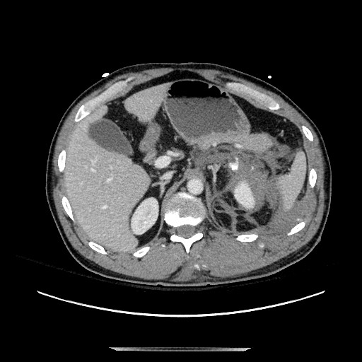 Blunt abdominal trauma with solid organ and musculoskelatal injury with active extravasation (Radiopaedia 68364-77895 A 37).jpg