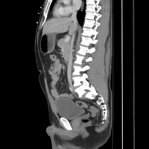 File:Blunt abdominal trauma with solid organ and musculoskelatal injury with active extravasation (Radiopaedia 68364-77895 C 70).jpg