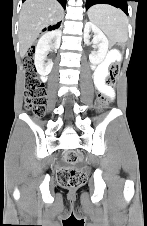 Blunt injury to the small bowel (Radiopaedia 74953-85987 B 68).jpg