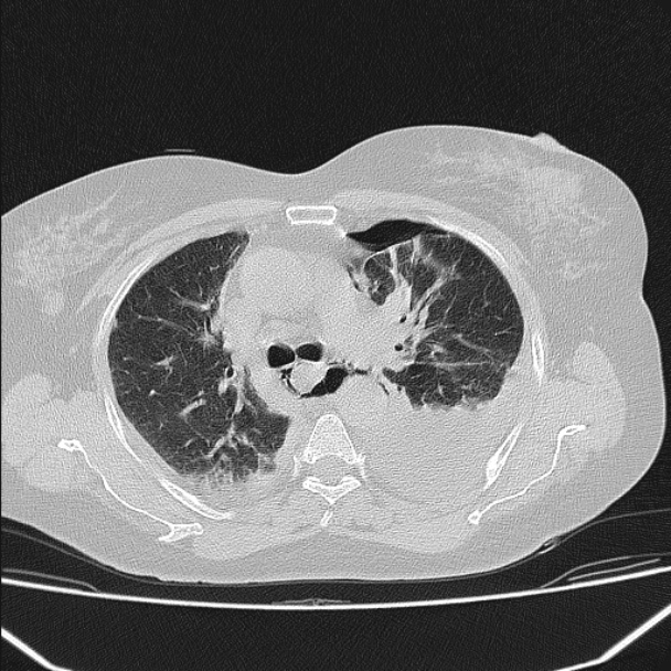 Boerhaave syndrome (Radiopaedia 45644-49799 Axial lung window 53).jpg